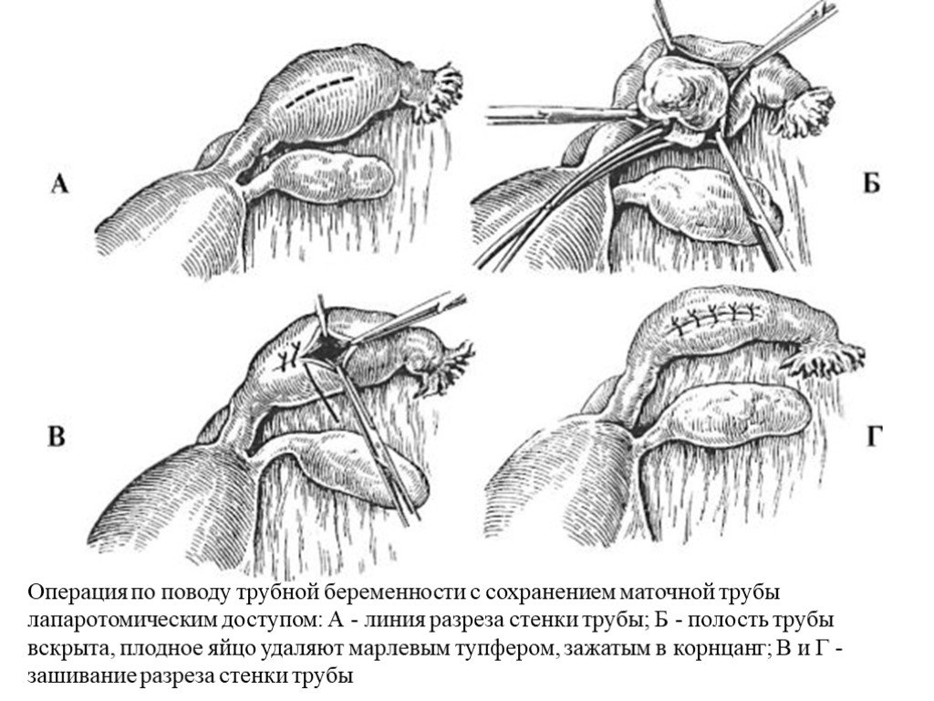 Культя после удаления матки фото