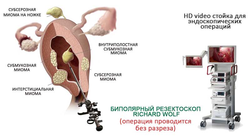 Удаление матки фото после операции