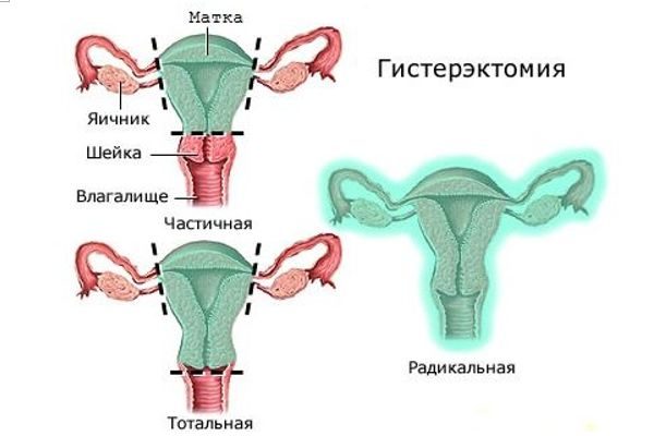 Последствия после удаления матки и яичников после 50 лет: Гистерэктомия