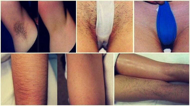 Шугаринг – фото до и после