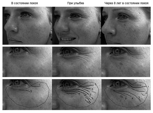 Причины возникновения борозд на лице и передовые косметологические методики их лечения