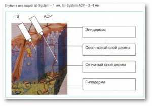 Как колоть биоревитализацию схема